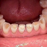 Worn Teeth